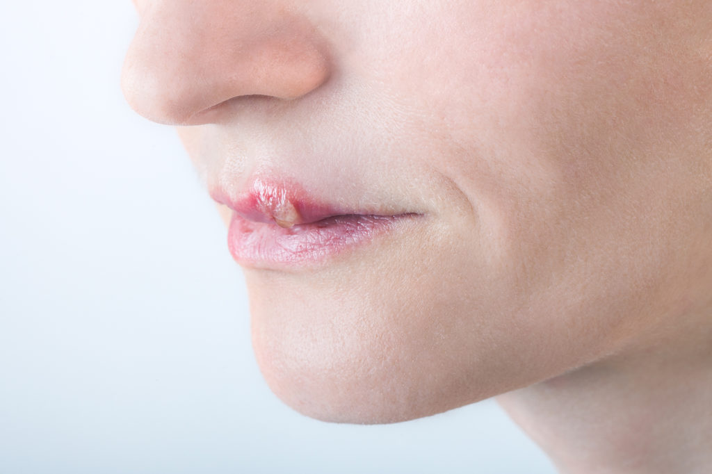 Honig: natürliches Mittel gegen Herpes